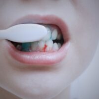 Aprende a solucionar el sangrado de encias y evita la periodontitis