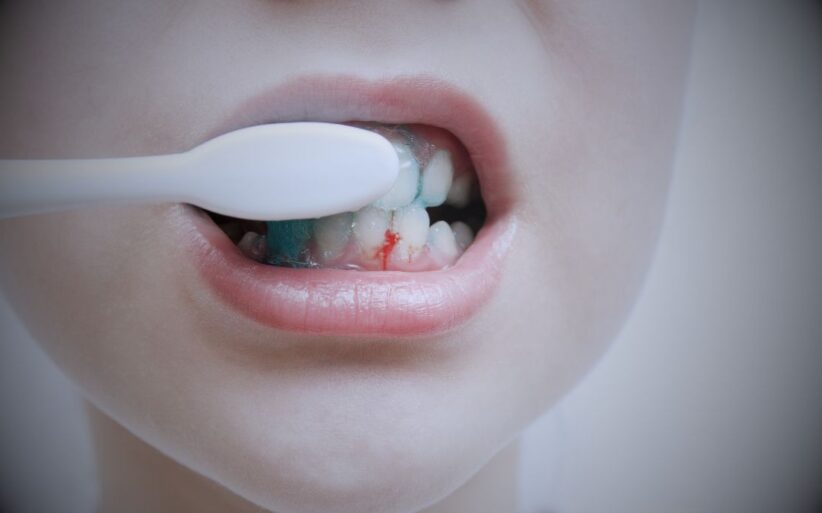 Aprende a solucionar el sangrado de encias y evita la periodontitis