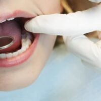 Sellado dental