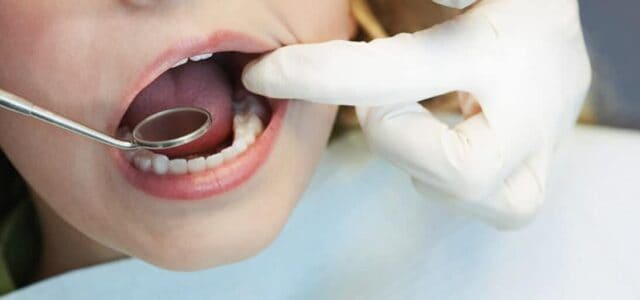 Sellado de fosas y fisuras Sellado dental