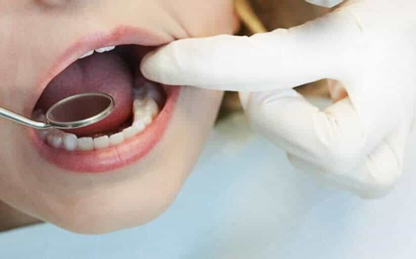 Sellado de fosas y fisuras Sellado dental
