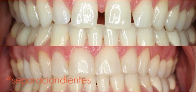 separación dientes incisivos separacion dientes despues ortodoncia