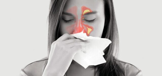 La elevación de seno causa sinusitis Sinusitis por elevación de seno