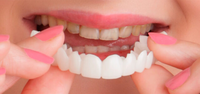 Snap on smile Snap on smile