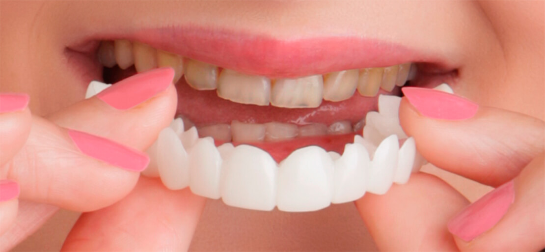 ¿Qué es Snap on Smile? Pros y contras de esta férula dental