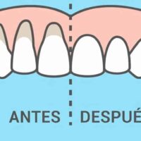 Comparativa entre encía normal y retraída