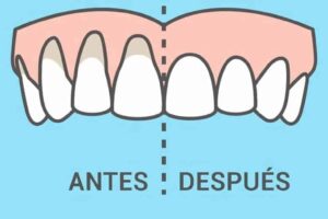 Comparativa entre encía normal y retraída