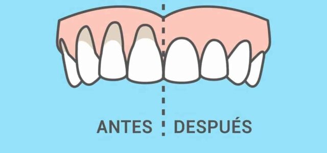 Solución para encía retraída Comparativa entre encía normal y retraída