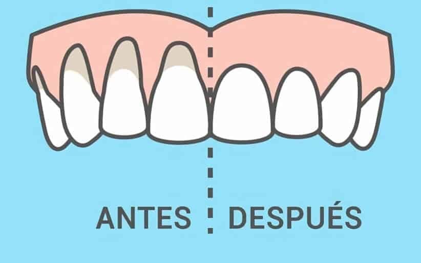 Comparativa entre encía normal y retraída