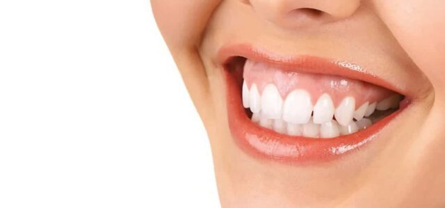 Cómo corregir la sonrisa gingival Cómo arreglar la sonrisa gingival