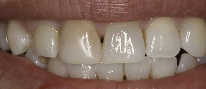 Antes de Invisalign y carillas dentales