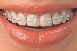 Tratamiento de ortodoncia con brackets