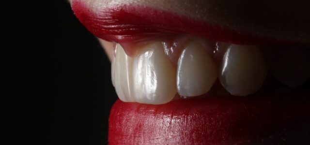 Carillas dentales de porcelana en incisivos