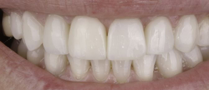 Después de Invisalign y carillas dentales