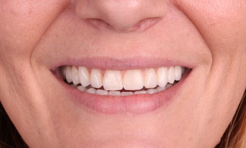 Protesis dental fija precio chile