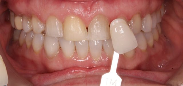 Carilla dental de porcelana