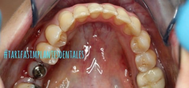 tarifas implantes dentales madrid clinicas de implantes dentales