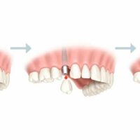 Pasos para colocar un implante dental