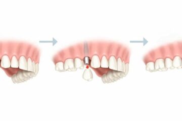 Pasos para colocar un implante dental