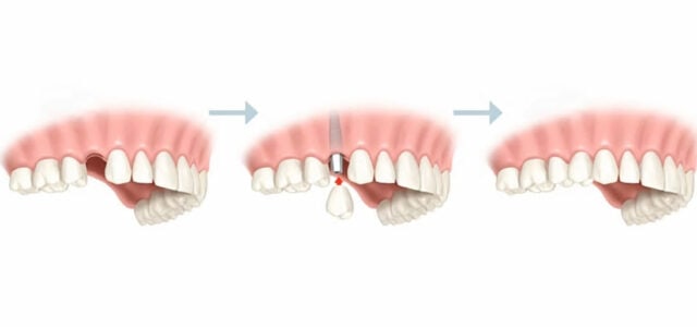 Pasos para colocar un implante dental