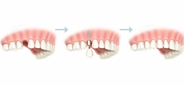 Tiempo de colocación de una corona Pasos para colocar un implante dental