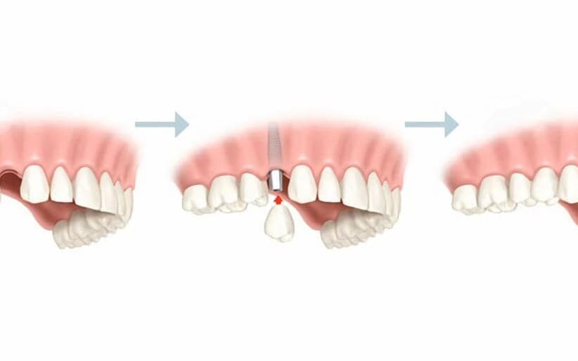 Pasos para colocar un implante dental