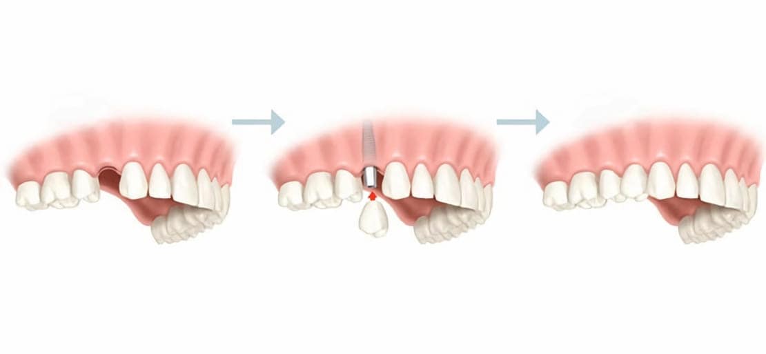insuficiente Cementerio habilidad Implantes dentales y cuánto tiempo tardan en cicatrizar | Ferrus&Bratos
