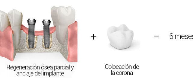 Implantes dentales con poco hueso
