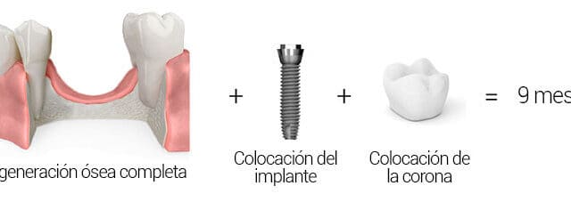 Alarga la colocación de implantes