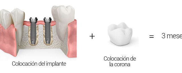 Corona sobre implante