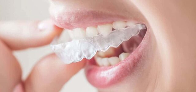 Tiempo uso de Invisalign Invisalign horas
