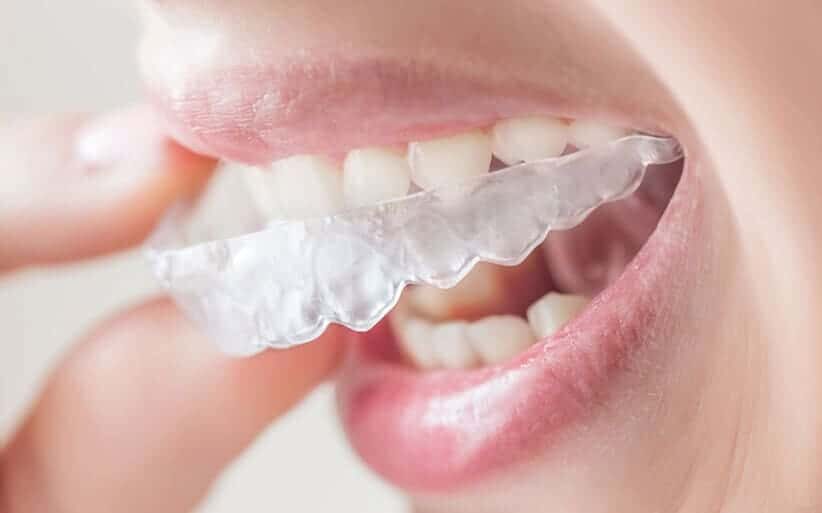 Invisalign horas