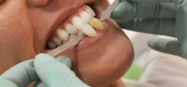 Blanqueamiento dental tetraciclinas Manchas por tetraciclinas