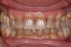 Tratamiento para blanquear los dientes con tetraciclinas