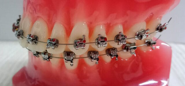 Brackets convencionales