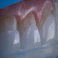 Aparece sonrisa con un tipo de carilla dental