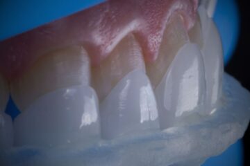 Aparece sonrisa con un tipo de carilla dental