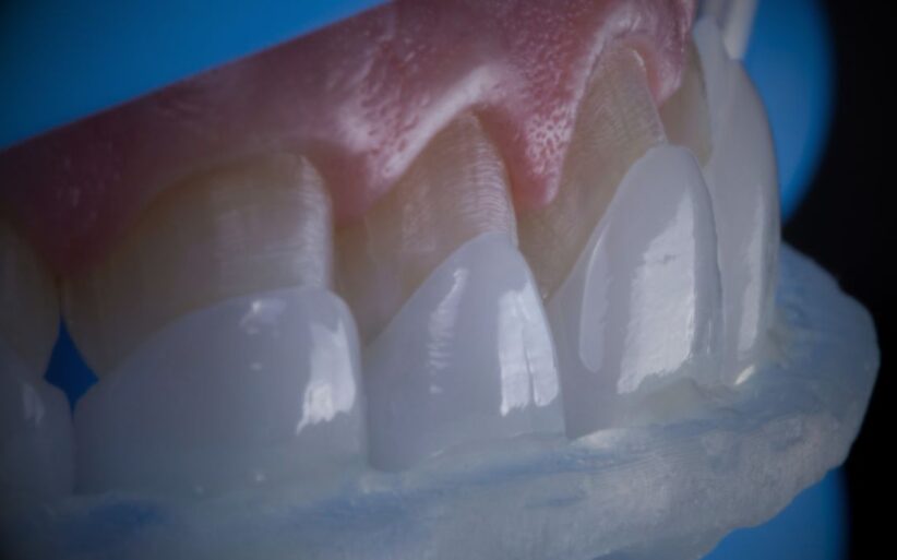 Aparece sonrisa con un tipo de carilla dental