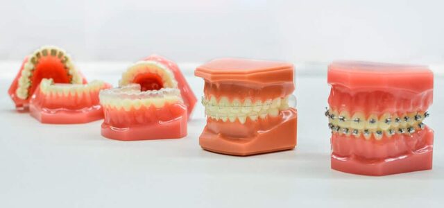 Tipos de brackets Mejor bracket
