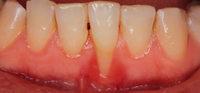 Raíz dental descubierta