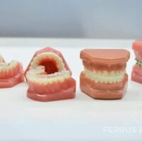 distintos tipos de ortodoncia