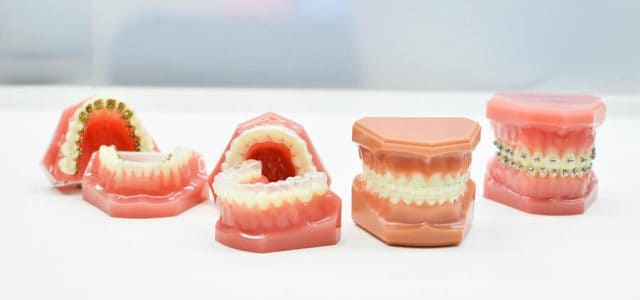 Clases de brackets dentales