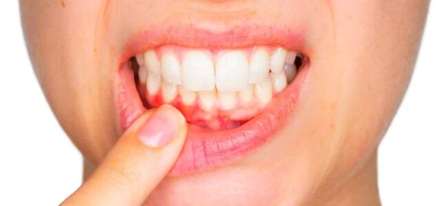Tipos de gingivitis Encías rojas