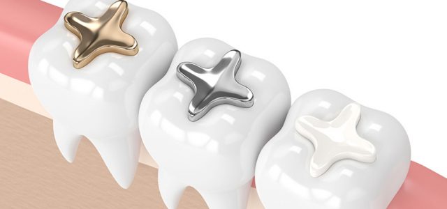 Materiales de una incrustación dental