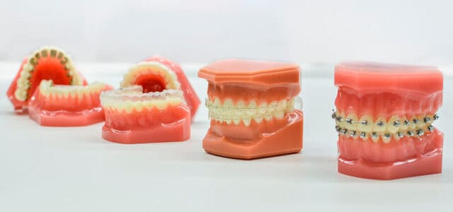 Brackets para personas adultas