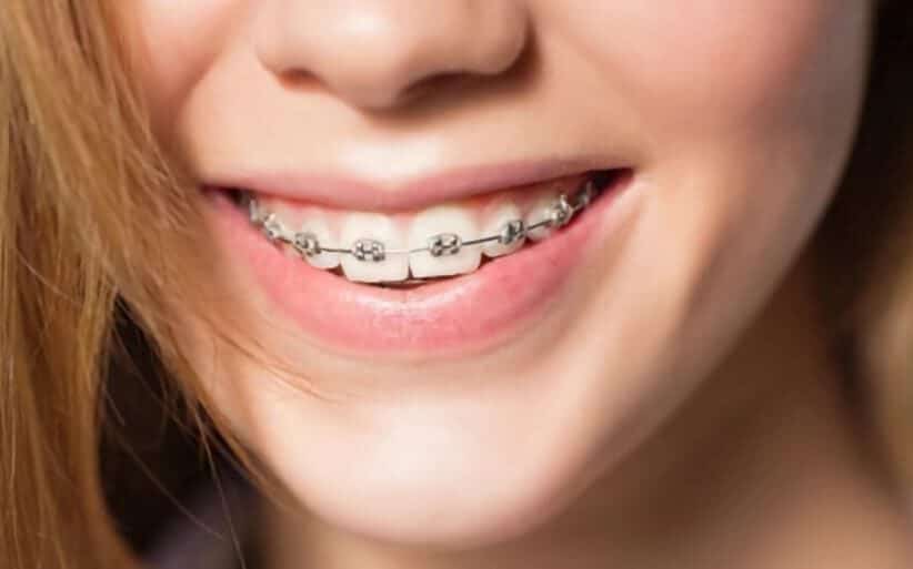 Tipos de ortodoncia para personas adultas