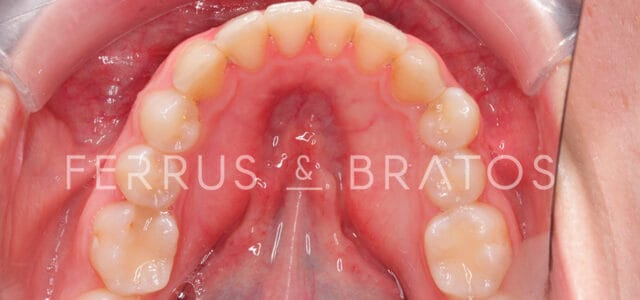 Torus mandibular