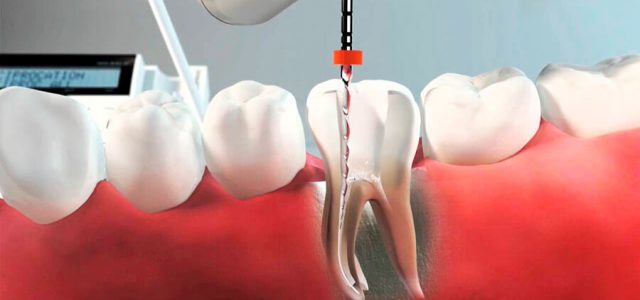 Pieza dental endodonciada