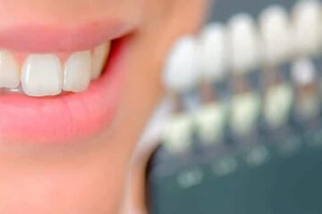 Dientes con calcificación