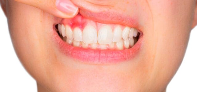 Enfermedad periodontal